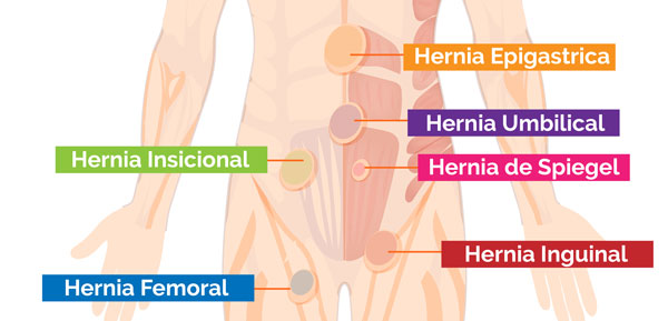Tipos de hernia
