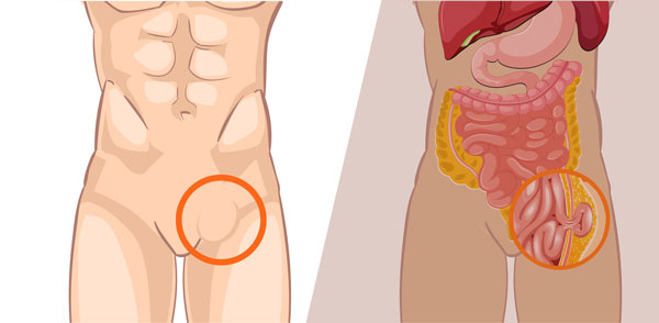 Diagnóstico de Hernia Inguinal