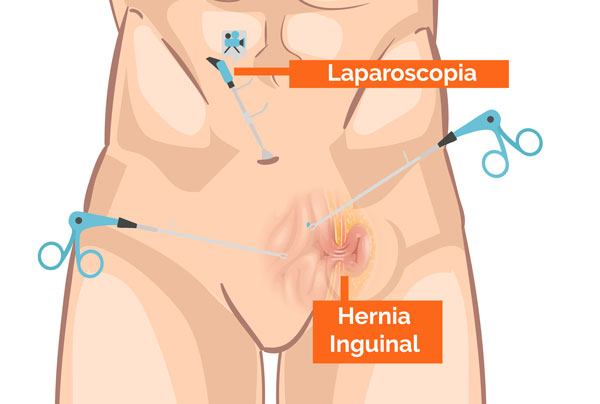 Tratamiento de hernia